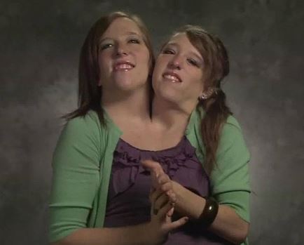  Together for Life, Literally – The Incredible Life of Conjoined Twins