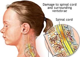  SPINAL CORD INJURY: SIGNS AND SYMPTOMS